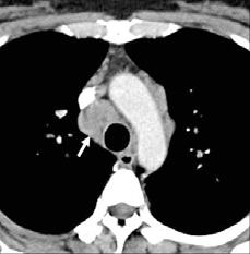The chest radiography () and CT ( and C) show homogenously enhancing lymph nodes in the right paratracheal (arrow on ), subcarinal, and both hilar areas (C).