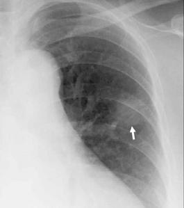 radiography () and CT () but the border is not as sharp as observed in a pleural or extrapleural lesion.