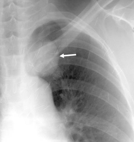 Tuberculosis and Respiratory Diseases Vol. 58. No. 6, Jun. 2005 Figure 3. Neurilemmoma arising from the intercostal nerve (an extrapleural lesion).