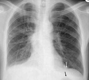 The erect chest radiographs show a shift in the right diaphragmatic dome lateral to the midline(), more than 2 cm between the left diaphragm