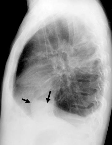 supine chest radiograph in another patient (D) shows an apical cap (arrow) and increased opacity in the right hemithorax suggesting a pleural