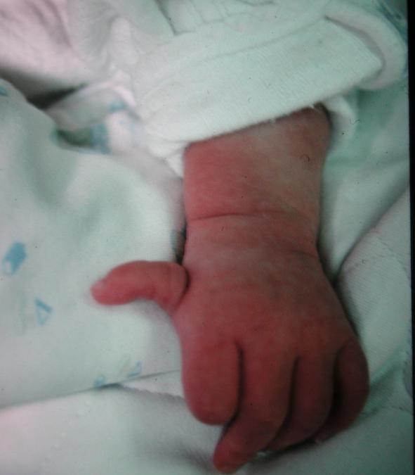 V. Undergrowth # Congenital hypoplasia of the thumb ( 선천성무지저형성증 ) Thumb: 수부전체기능의 40% Absence of thumb: 현저한기능저하, 재건술통한기능회복필요함 경한경우 web