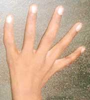 장애 반드시 op 필요 radial most finger 의 pollicization 3 동반기형은 polydactyly 가가장흔함 4 수술시기는대개 1