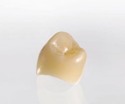 모든 세라믹 재질은 인체에서 거부반응을 유발하지 않고, 치아와 유사한 특성을 갖추고 있으며, 최대한 자연치아 조직을 보존할 수 있습니다.