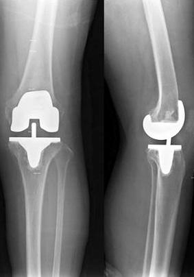 An 72-year-old woman had TKA with PFC Sigma RP-F R. She is able to sit cross-legged and take kneeing position. 2.