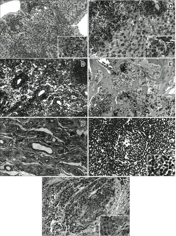 174 J Korean Cancer Assoc 2001;33(2) Fig. 5. Histomorphologic and PSA immunohistochemical characterization of both the primary and metastatic prostate tumors of P & T sublines. A. Primary tumor (H & E, 200).