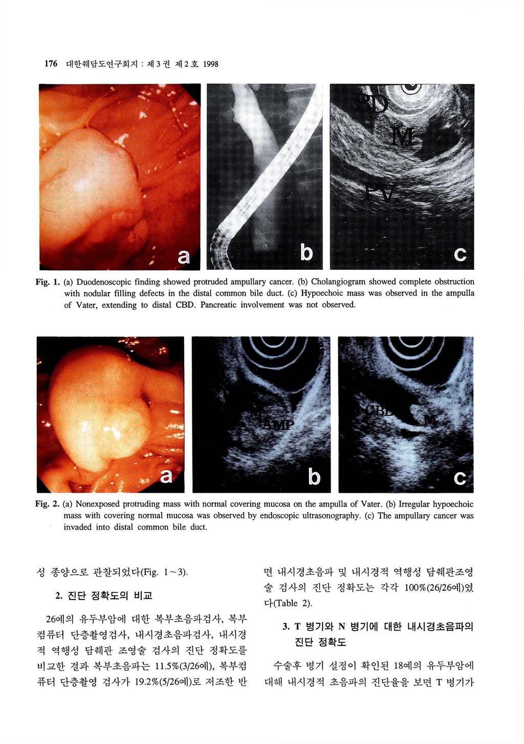 176 대한춰 l 담도연구회지 : 제 3 권제 2 호 1998 Fig. 1. (a) Duodenoscopic finding showed protruded amp비 lary cancer.