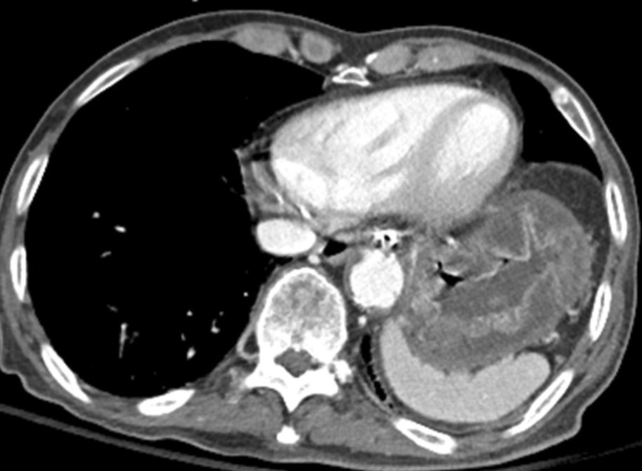 Abdominal CT finding.