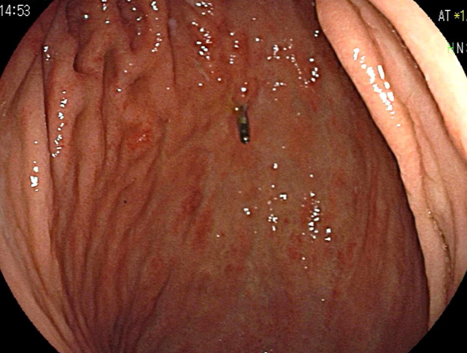 remain but ulcer exudates or hemorrhage