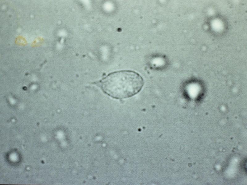각각의질염대한간단한개관 그림 칸디다알비칸스라고하는곰팡이종류에의하여감염되어생기는데비지같은냉과심한가려움이특징입니다