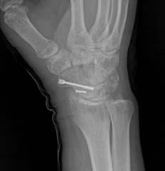 D. Radiograph after 1 year from