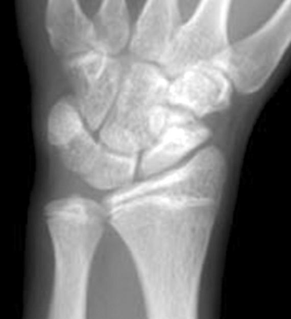 말발굽골이식과 Herbert 나사및초소형나사를이용한주상골불유합의치료 655 Fig. 3. A 17 year-old man with pain of left wrist for 1 year.