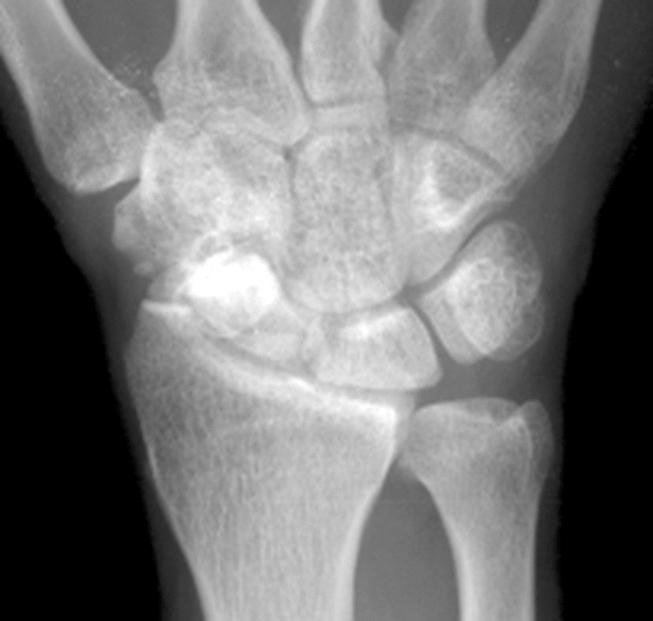 656 강호정ㆍ박 훈ㆍ한수봉 Fig. 4. A 35 year-old man with pain of right wrist for 14 years.