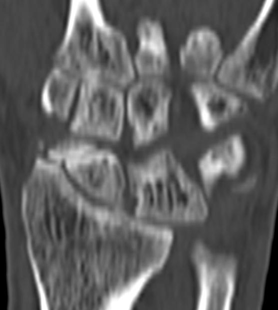 (C, D) Postoperative radiograph show complete reduction & union 5 months after surgery.