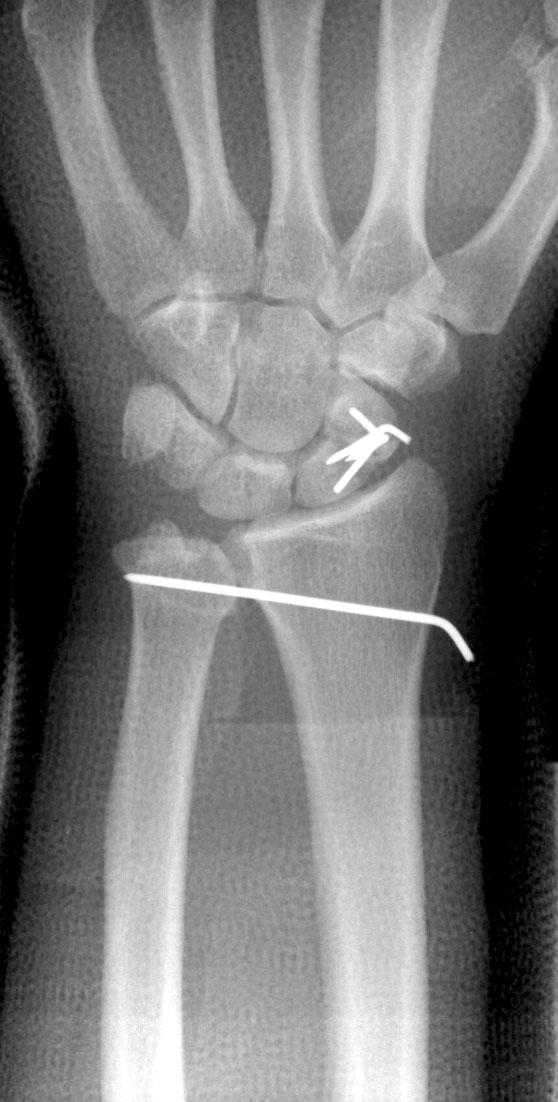 fracture and percutaneous K-wire transfixation for the dislocation of distal radioulnar joint. 79 Fig. 4.