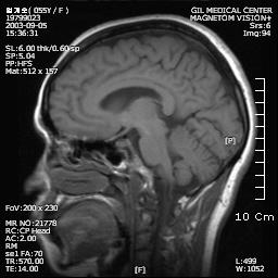 환자는 2003년에어지럼증으로본원외래를방문하여뇌 MRI(magnetic resonance imaging) 를촬영하였는데, 당시양측대뇌피질의경한위축이외에는특이소견을관찰할수없었다 ( 그림 2).