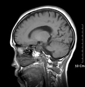 parietal, and temporal cortices, especially right than