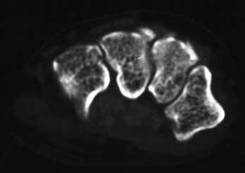 640 강호정 조승배 정재민외 3 인 Fig. 3. Computed tomogram-separate accessory ossicle with associated degenerative change was seen on the capitate and trapezoid. 동반하지않고발견된 2예에서 1예는 5개월, 1예에서는 2개월만에통증이발현되었다.
