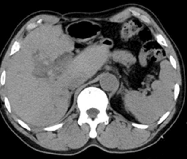김세준, 김두배 : 신장경을이용한간내담석제거술 : 세계첫증례보고 Fig. 2. Abdominal computed tomography (CT) imaging of the patient.