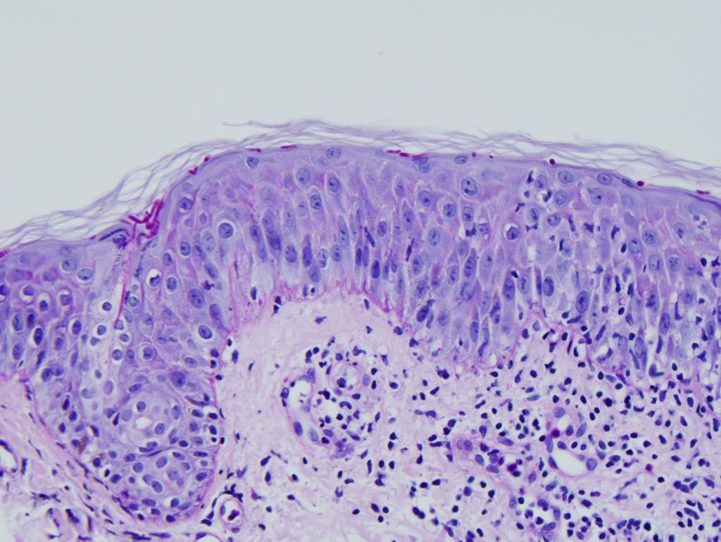 Direct microscopic examination of some scales removed by scraping the lesion demonstrated several septated long hyphae (KOH