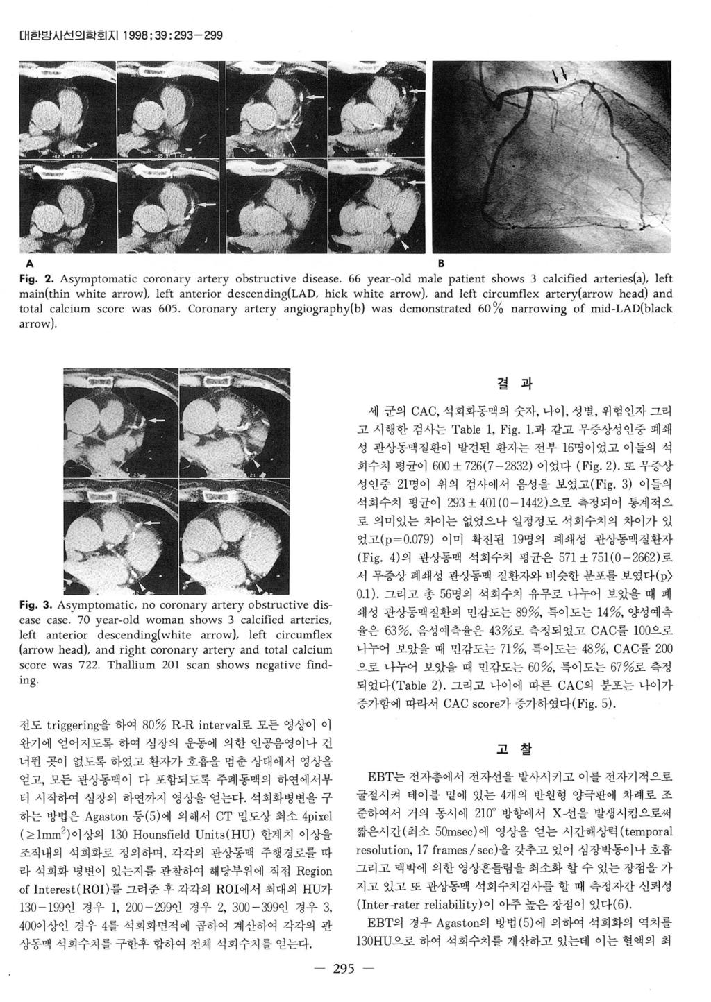대한방사선의학회지 1998; 39: 293-299 A B Fig. 2. Asymptomatic coronary artery obstructive disease.