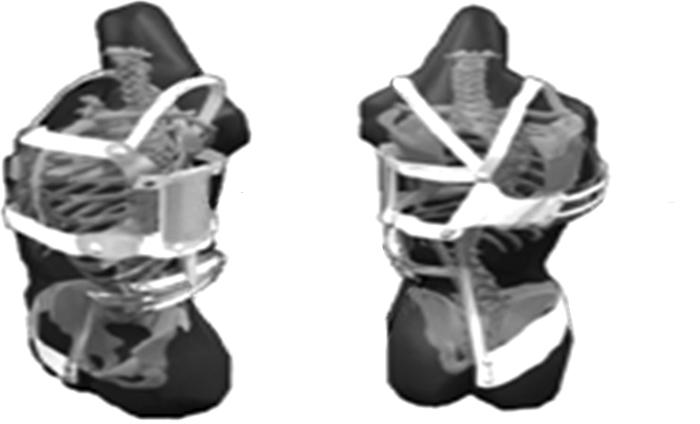 송준찬 척추 측만증 보조기의 제작 5) 척추측만증 보조기의 일반적 종류 () 밀워키 보조기(Milwaukee Brace): 밀워키 보조기는 골반에서 목까지 위치시켜 척추의 균형을 취한 상태에서 목에서