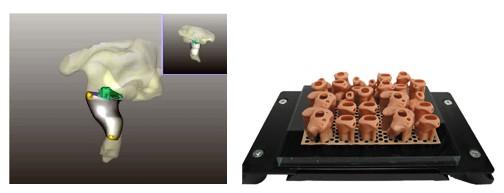 2012 년벨기에의료진은 3D 프린터로제작한인공턱을최초로이식하는데성공 티타늄을소재로하여레이저방식으로제작된인공턱은 107g