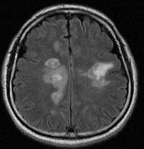 lesions in bilateral frontal lobes, right parietal lobe and corpus callosum.
