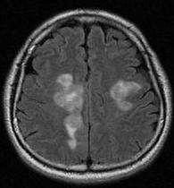 9개월전뇌경색진단시시행한뇌 MRI에서양쪽백질부위에종창성병변이관찰되었고 (Fig. 1).