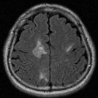 환자의이번증상은척수병변으로의심되었으나척추 MRI는정상이었다 (Fig. 2-D). 뇌척수액검사에서백혈구는 23/mm 3 ( 림프구 80%), 단백질은 92.