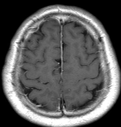 MRI 소견은 백질의 혈관성 부종 병변과 불 완전한 고리 형태의 조영증강(open-ring