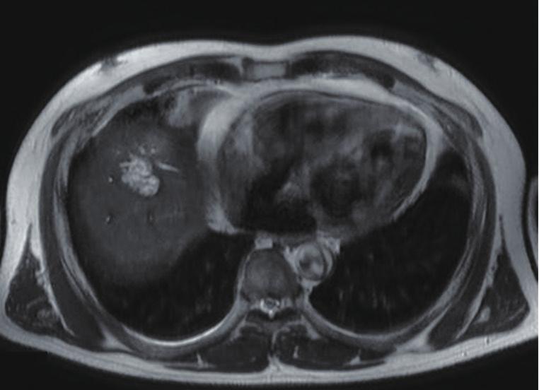 73 mg/ dl. B A B C Fig. 1. Selected images of this case from various preoperative image modalities.