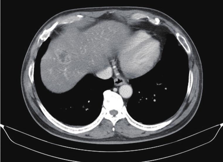 (B) Portal venous-phase contrast-enhanced computed tomography (CT) scan showing approximately 3 2 cm of a heterogeneously low