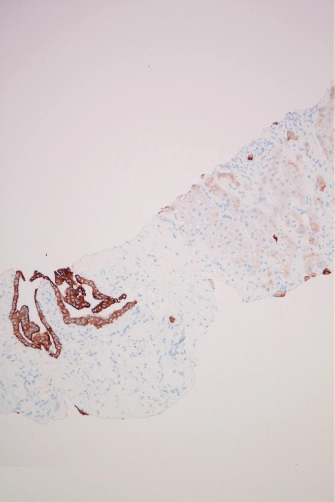 (B) Immunohistochemistry using pan-cytokeratin reveals reactivity with the epithelial component (pan-cytokeratin, 200), but (C) negative for vimentin due to an absence of a sarcomatous