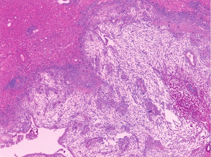 Sung Min Kong, et al. 고 찰 병인 중 하나로 제시하기도 하였다. 간내 육종양 담관암과 일 반적인 간내 담관암을 조직학적 확진 전에 미리 구별하는 것 육종양 암종은 방추세포암(spindle cell carcinoma)이나 가 은 매우 어렵다.