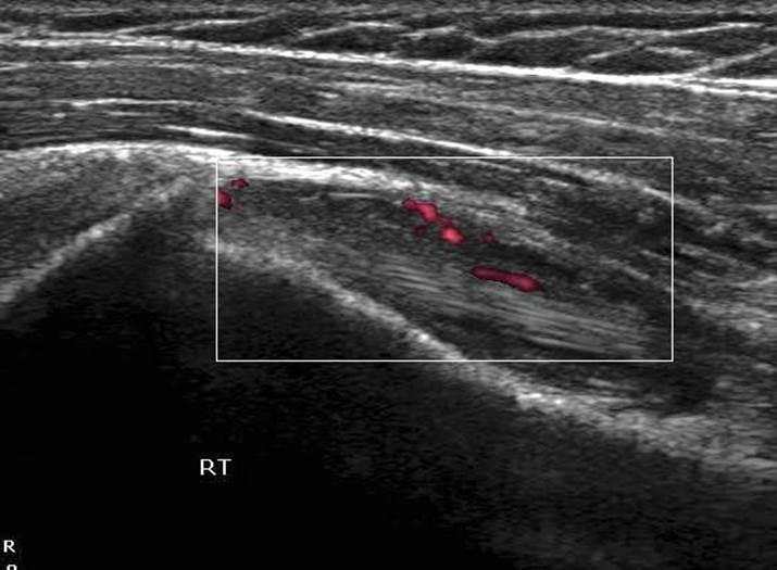 anechoic fluid (*) within the tendon