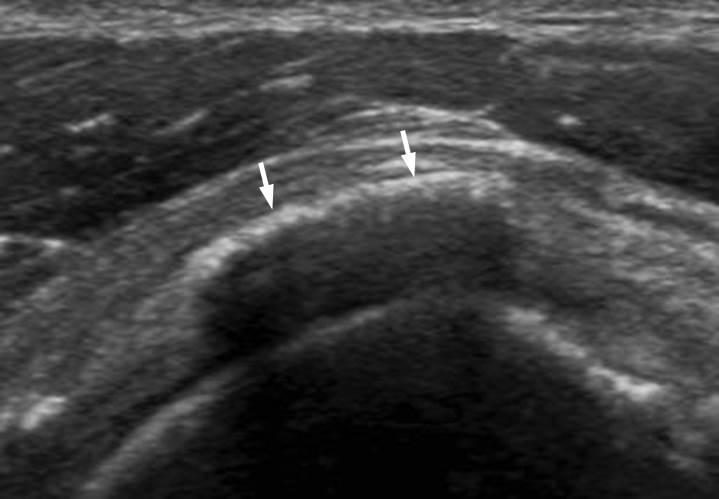 - Hae-Rim Kim. Ultrasonographic assessment for shoulder pain - 석회성건염 (calcific tendinitis) 가시위오목근에서흔하게발생하며골부착 1 cm 이내의위험대에잘발생한다 [4].