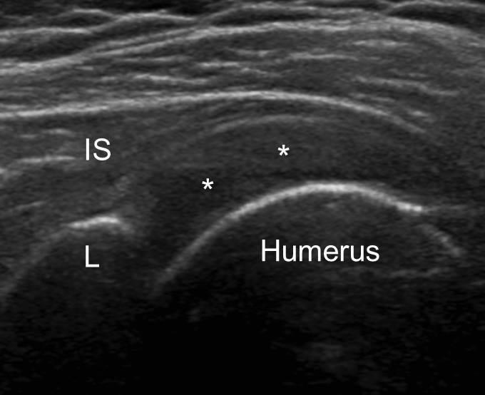 () Longitudinal and () transverse ultrasonographic images show hyperechogenic linear lesion (arrows) with faint posterior acoustic shadowing in the tendon. Figure 4.