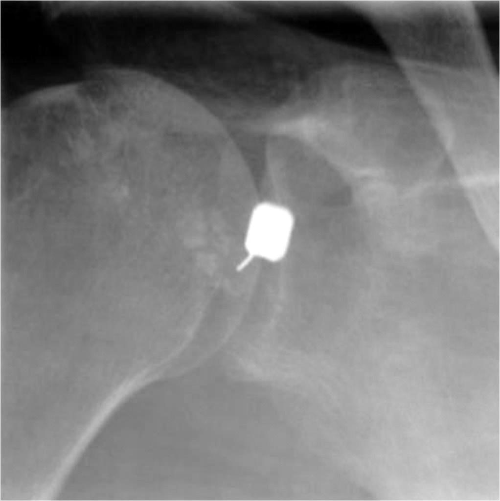 유고은외 A B C D Fig. 1. Position and puncture site of anterior and position approach in shoulder magnetic resonance arthrography.