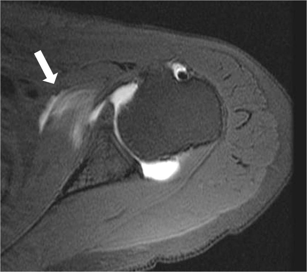A B C D Fig. 2. Contrast leakage on shoulder magnetic resonance arthrography with fat suppressed T1-weighted images with axial plane. A.
