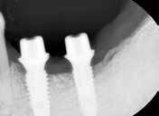 P25 Digital Abutment Product