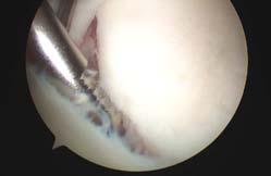 상부관절와순전후병변 SLAP lesion SLAP repair 상부관절와순전후병변