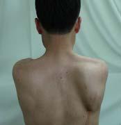 scapular motion from behind the patient during Flexion