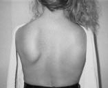 winging) Type 3 prominence of superior scapular border