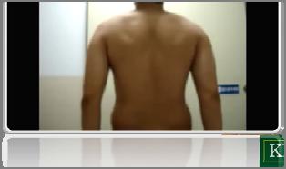 Scapular dyskinesis Excessive scapula protraction with +