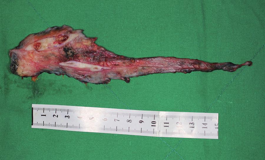 Preoperative plan radiograph shows multiple calcification widely distributed in the subcutaneous region of the forearm and wrist. 1).