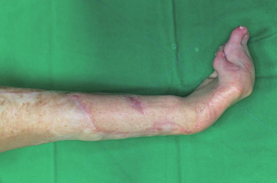 Jae Hyun Kim, et al. Heterotopic Ossification in Post-Burn Scar Contracture of the Wrist Fig. 5. Postoperative photograph 1 year 9 months after the surgery. Fig. 6.