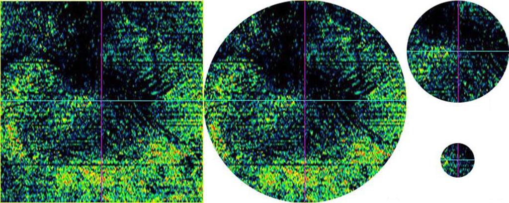 - 안성현 외 : 망막앞막과 정면빛간섭단층촬영 - A B C D Figure 1. Four types of En Face optical coherence tomography (OCT) images.