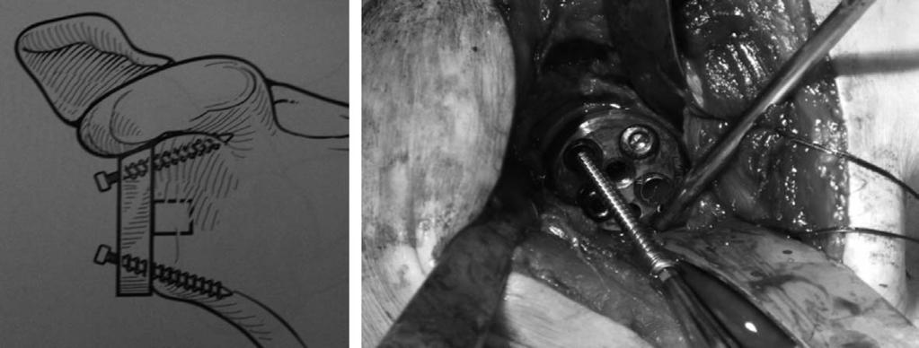 정석원 : 역행성견관절전치환술 - 수술기법및주의점 - Fig. 6. () Divergent superior and inferior screw at coracoids base and lateral pillar to increase shear force, () nterior and posterior screw for rotational stability. 5.