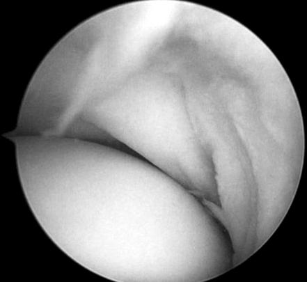 366 Si-Jung Song, et al. A B C Figure 3. (A) During the arthroscopic examination, a thickened plica was observed anterior to the radiocapitellar joint (arrow).